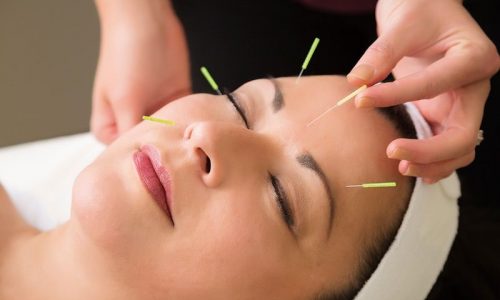 facial-acupuncture